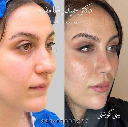 اگر به دنبال نتیجه ای طبیعی و بدون عوارض هستید؛ جراحی بینی خود را به دکتر مفرد بسپارید